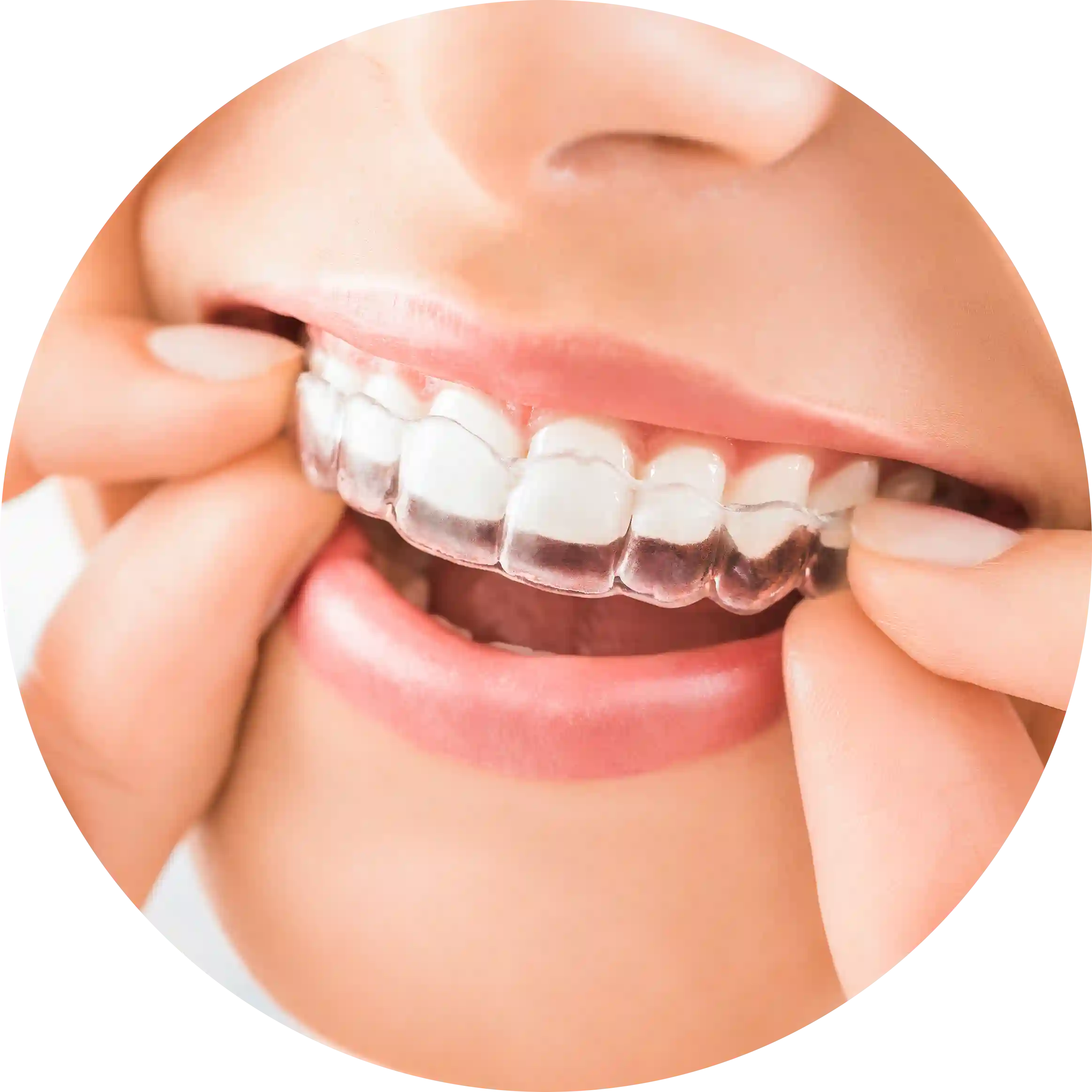 Transparente Aligner
