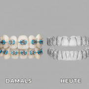Zahnspange früher vs. Heute