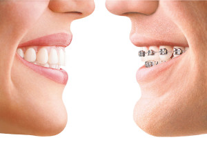 Zahnspangen Zahnregulierung